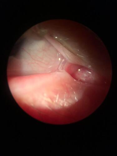 Silicone tube in the lacrimal drainage system